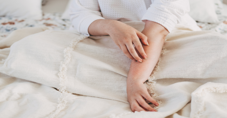 This Eczema Drug Just Got an FDA-Approved Upgrade