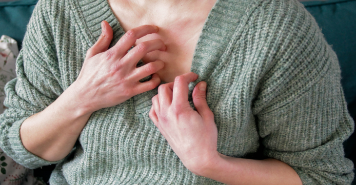 My Chronic Hives Started at 62 and I Thought They Were My Fault