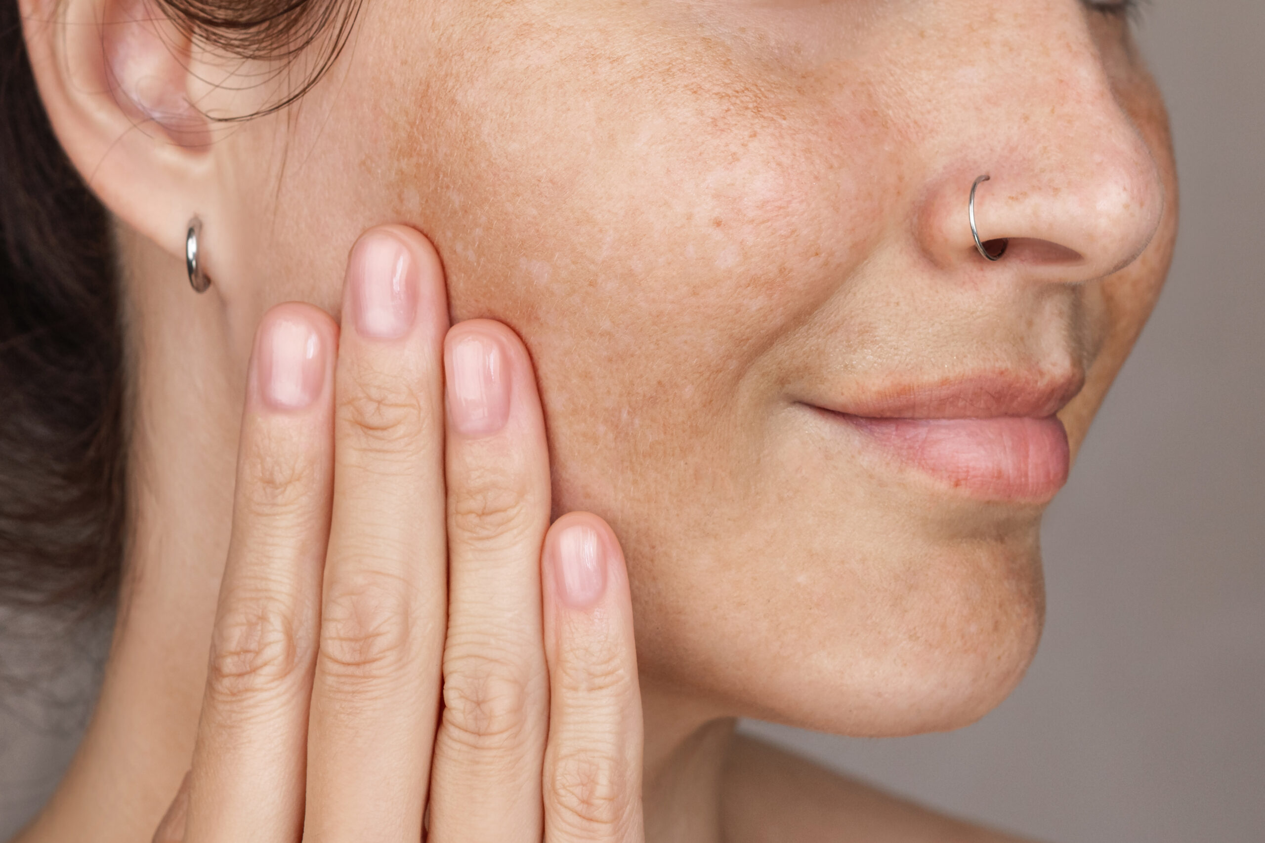 Laser or Microneedling? How to Know Which Treatment Your Skin Actually Needs