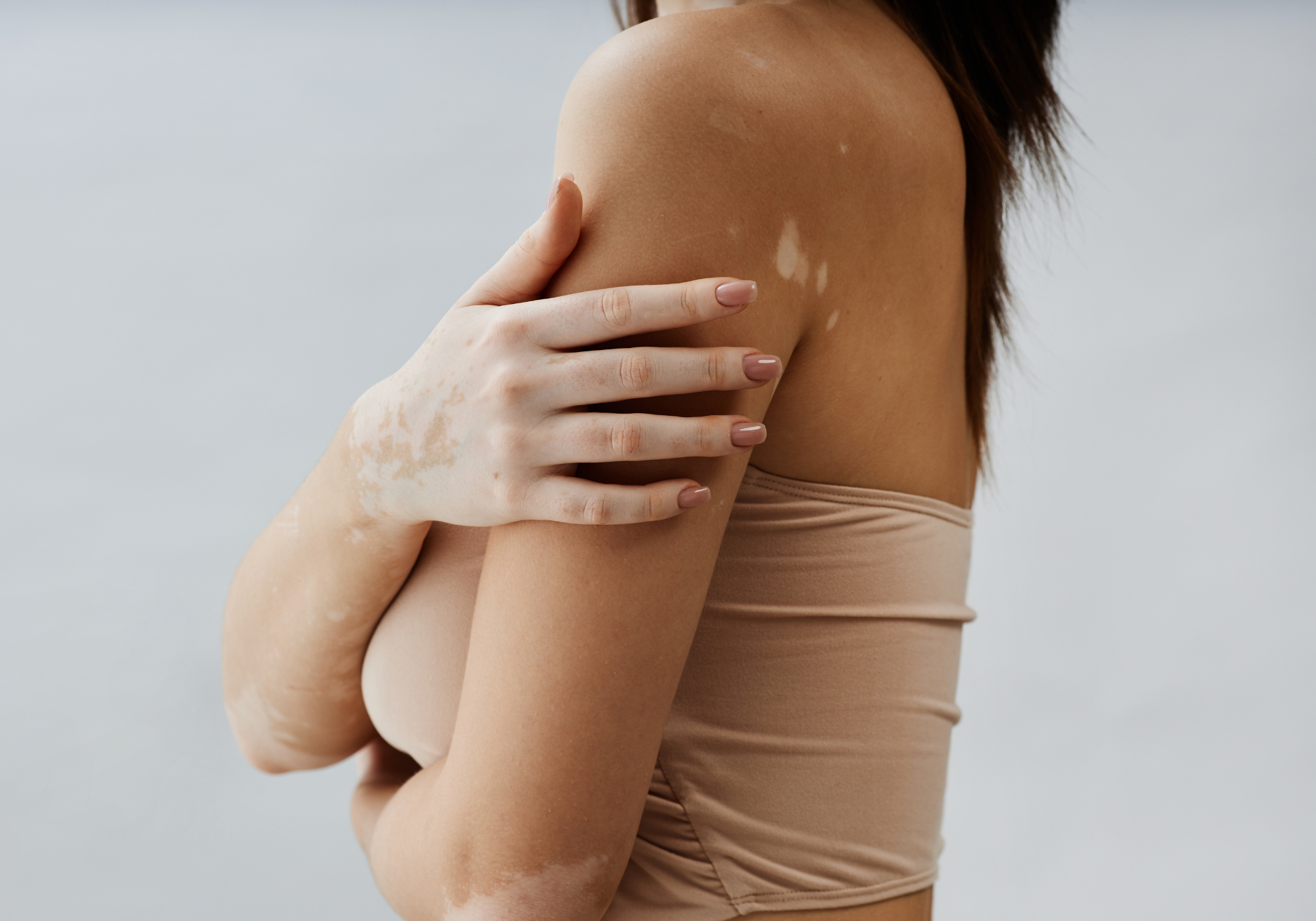 New Study Shows This Vitiligo Cream Working in Just 3 Months