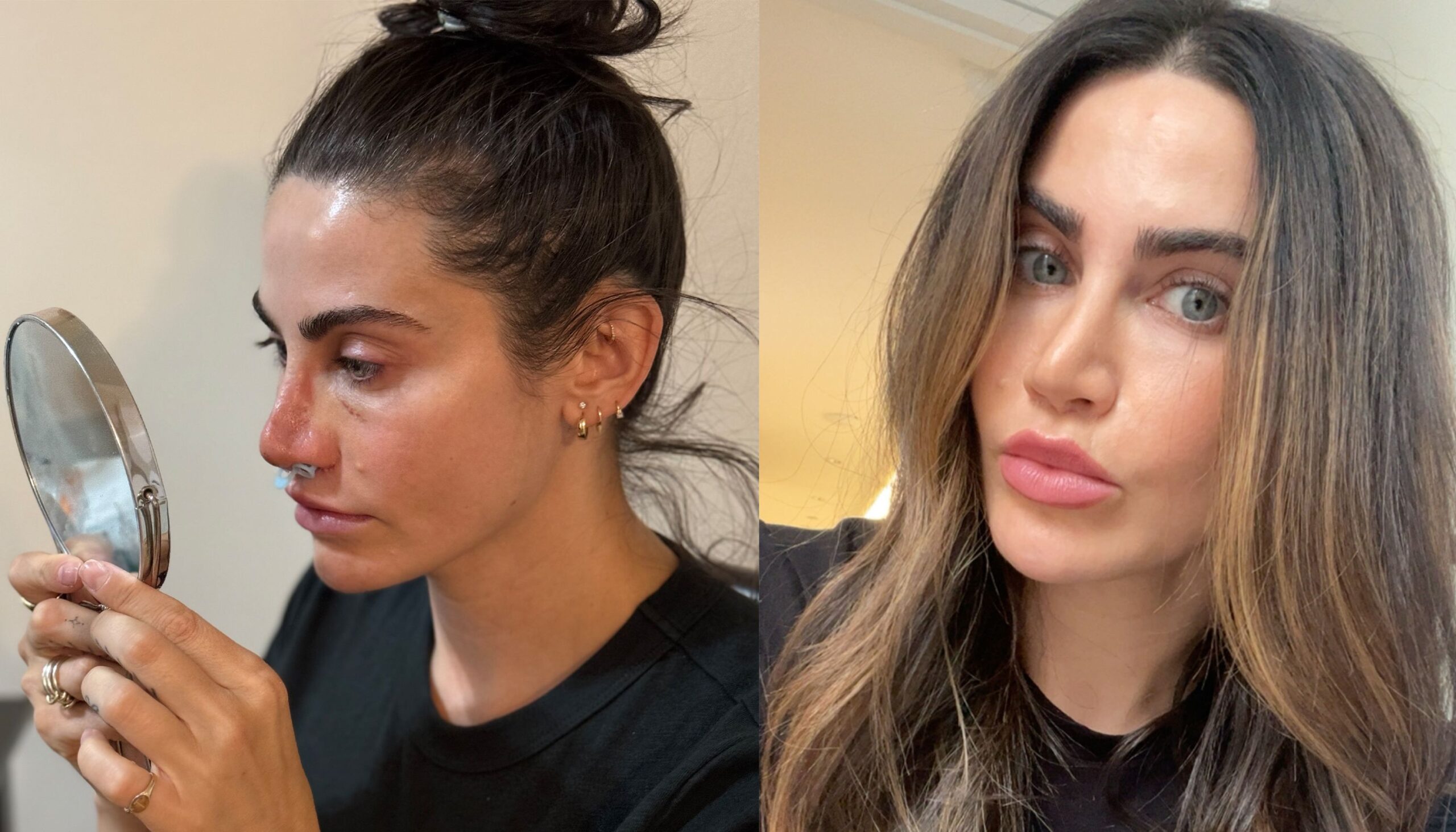 I Got a Rhinoplasty as a Beauty Editor—Here's My Honest Review, One Year Later