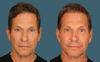I’m a Plastic Surgeon—Here’s How I Chose My Own Facelift Surgeon