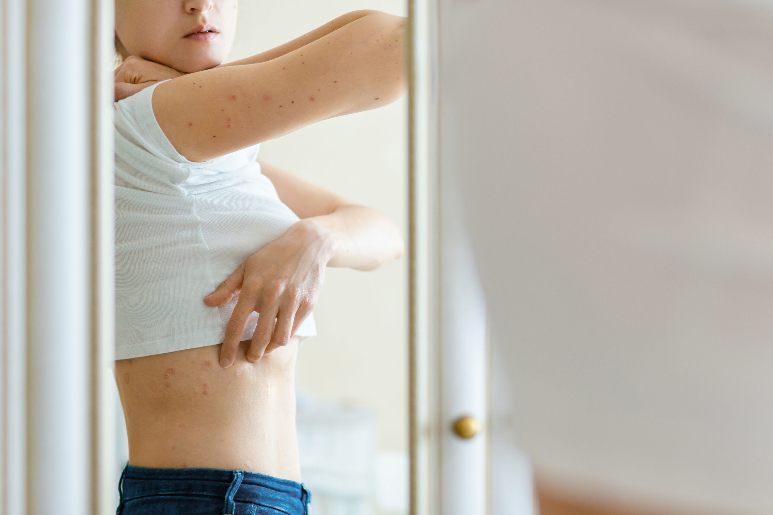 Do I Have Psoriasis or Is It Just a Rash?